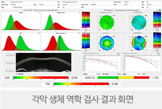 3. 각막 강성도 검사