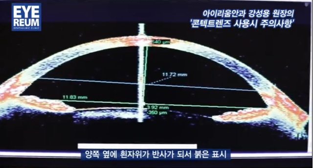 콘텍트렌즈 착용시 주의사항 - 강성용 원장
