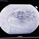 [언론보도] 아리랑TV - 강성용 원장님 인터뷰 '망막혈관 폐쇄증'