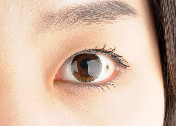 무심코 지나치기 쉬운 눈 속의 점 ! 악성 종양이 될 수도 있습니다.