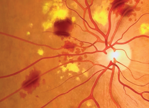 앞이 보이지 않게 될 수도 있다! 무서운 당뇨병 합병증