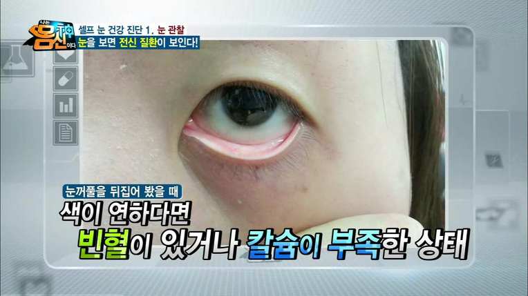 눈 맞춤으로 당신의 건강을 알 수 있다!