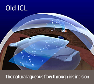 Old ICL-The natural aqueous flow through iris incision