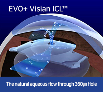 EVO+ Visian ICL™-The natural aqueous flow through 360㎛ Hole