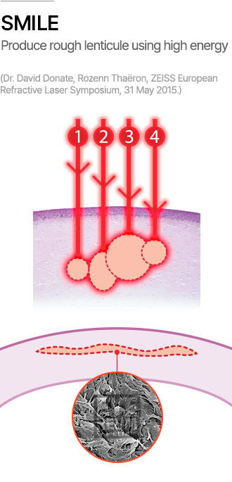 SMILE Produce rough lenticule using high energy (Dr. David Donate, Rozenn Thaëron, ZEISS European Refractive Laser Symposium, 31 May 2015.)