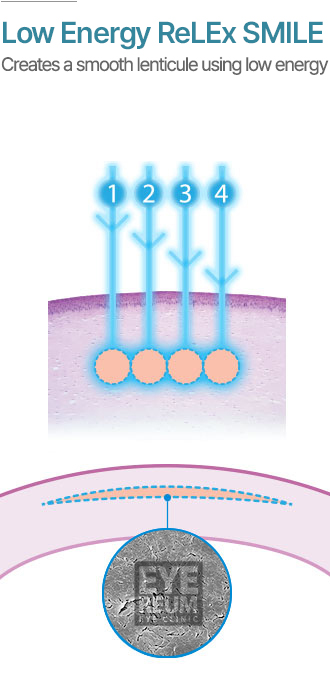 Low Energy ReLEx SMILE Creates a smooth lenticule using low energy.