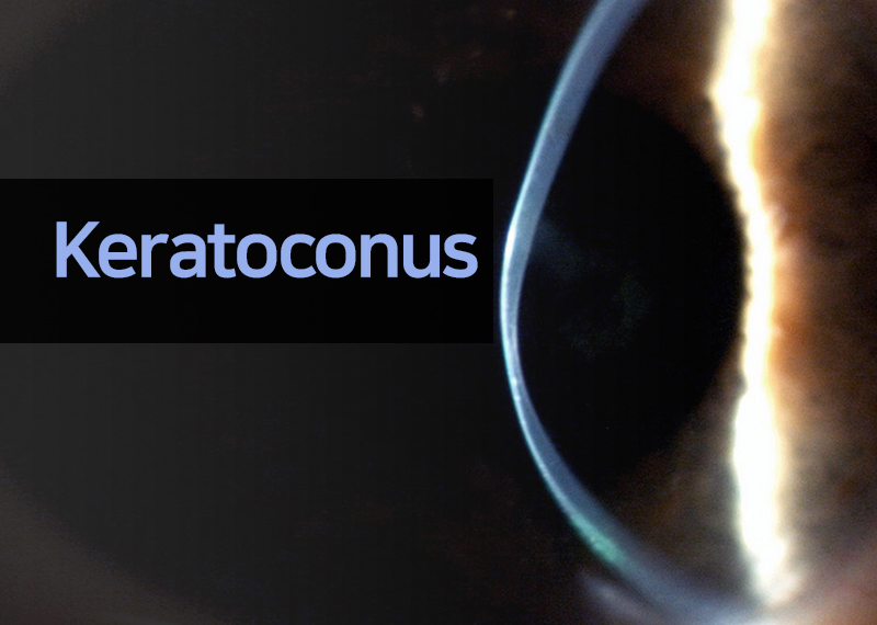 Keratoconus