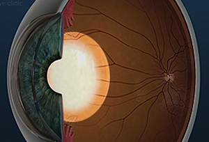 백내장 증상과 치료