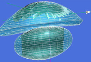 레이저를 이용한 백내장 수술