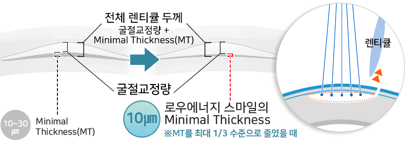 렌티큘 굴절교정량