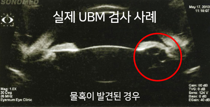 UBM검사를 통해 물혹이 발견되어 렌즈삽입 수술을 받을 수 없었던 사례