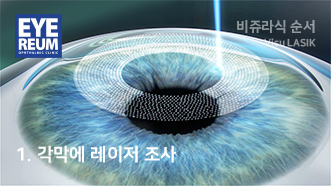 1. 각막에 레이저조사