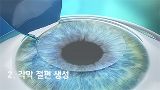 2. 각막 절편 생성