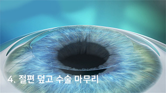 4. 절편 덮고 수술 마무리