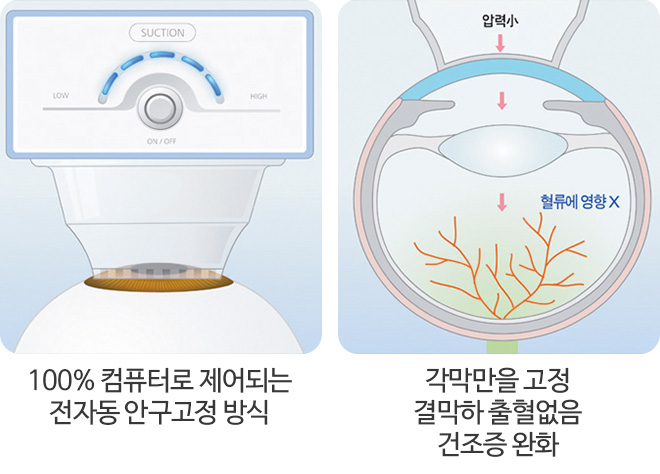 전자동 안구고정 방식