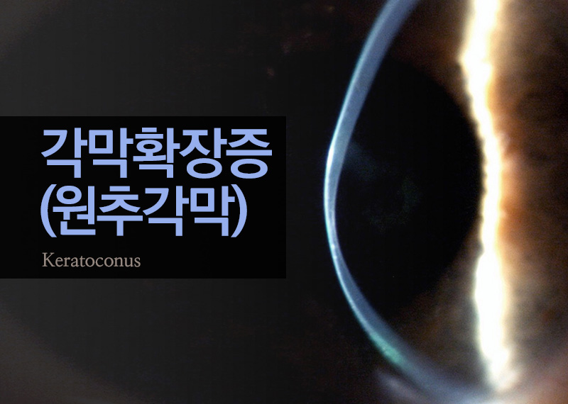 각막확장증(원추각막) | 아이리움안과