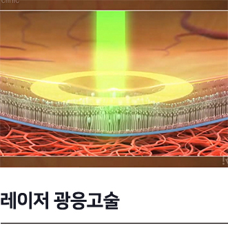 레이저광응고술