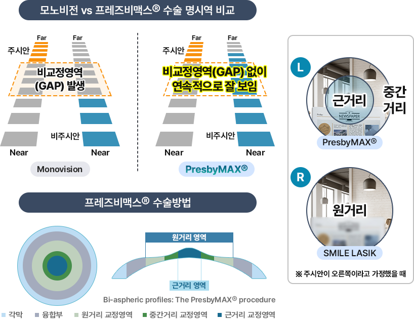 프레즈비맥스® 수술방법 / 모노비전 vs 프레즈비맥스®수술 명시역 비교)