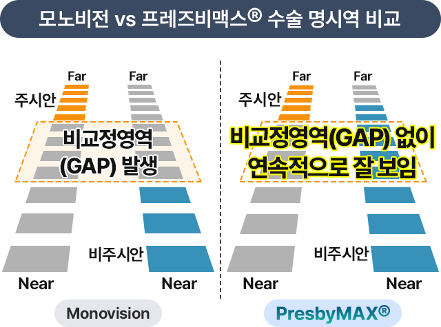 프레즈비맥스® 수술방법 / 모노비전 vs 프레즈비맥스®수술 명시역 비교)