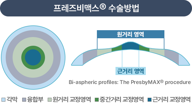 프레즈비맥스® 수술방법 / 모노비전 vs 프레즈비맥스®수술 명시역 비교)