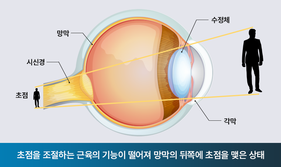 초점을 조절하는 근육의 기능이 떨어져 망막의 뒤쪽에 초점을 맺은 상태